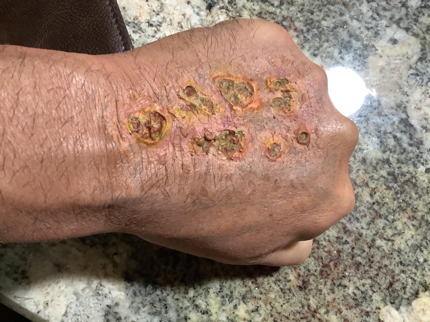 Realistic oozing, scabby lesions and sores prosthetic. Made from Monster latex or as a pros aide Transfer.